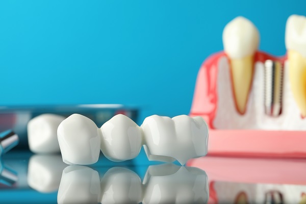 What Conditions Would Require Dental Bridges?