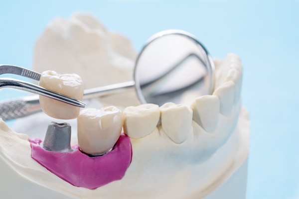 A Dental Crown For A Broken Tooth