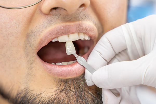 How Dentists Can Make Dental Veneers Look More Natural
